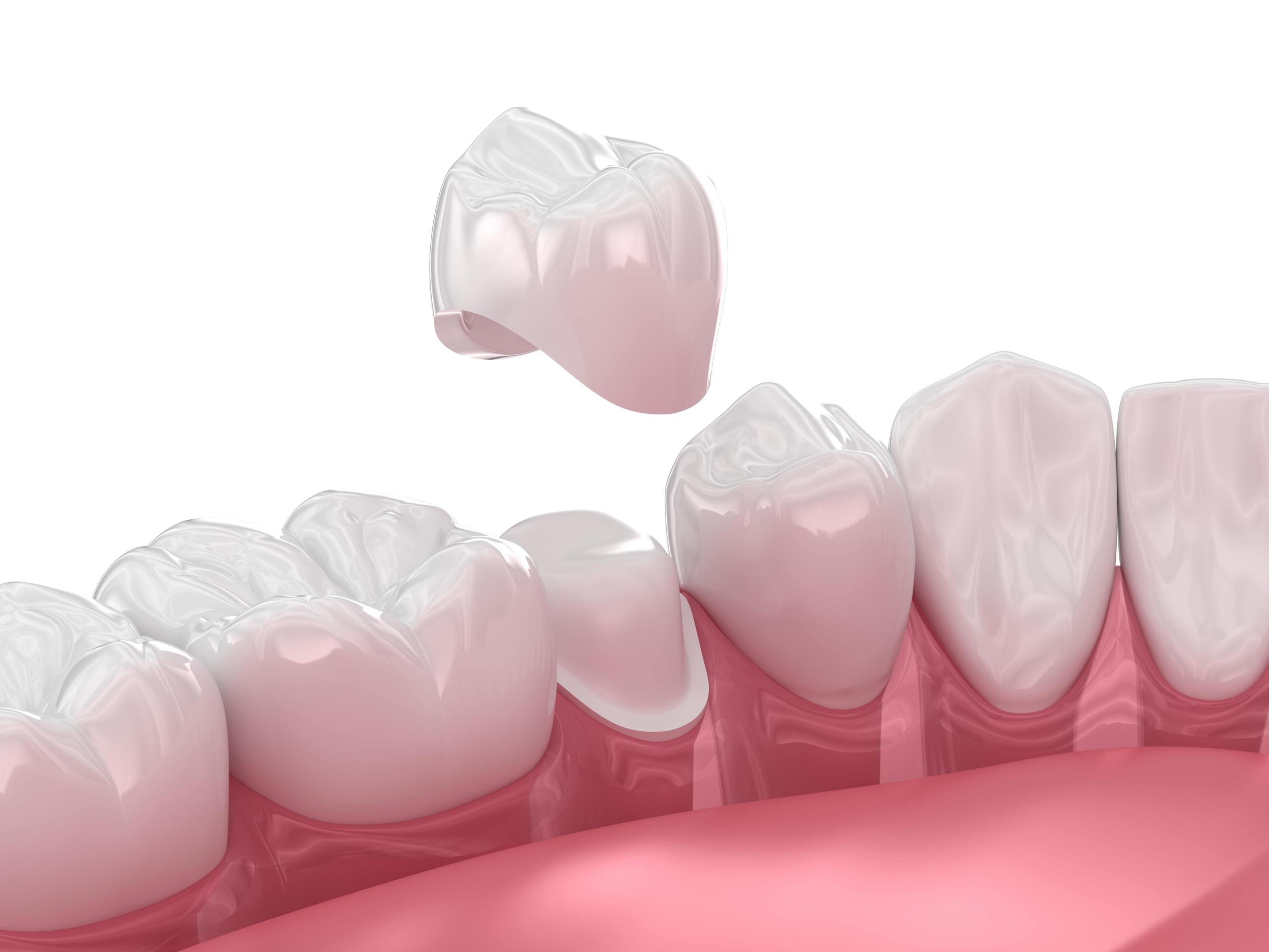 Dental Crown vs. Bridge: Making the Right Choice for Your Smile