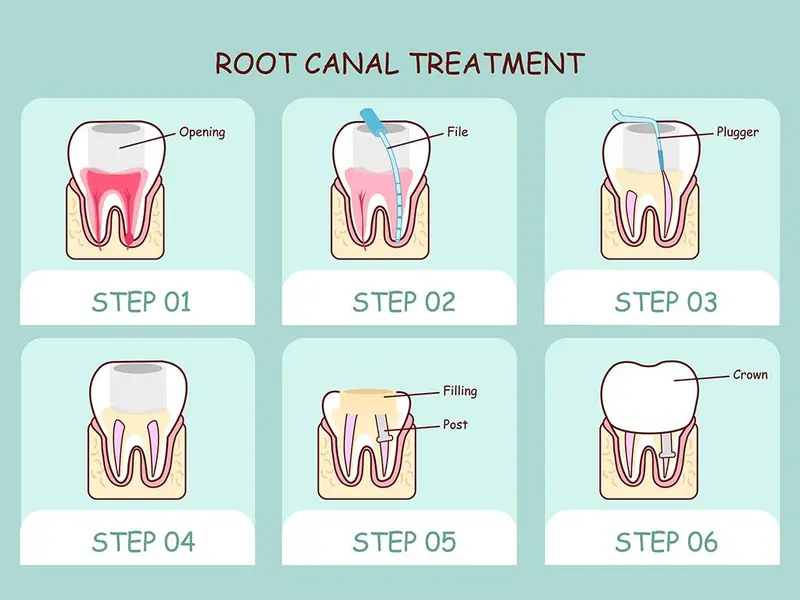 Do I Need a Root Canal?