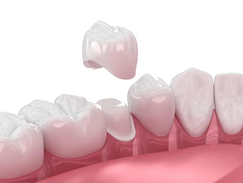 Dental Crown vs. Bridge: Making the Right Choice for Your Smile