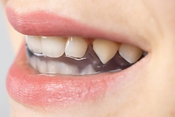 Bruxism mouth guard in mouth