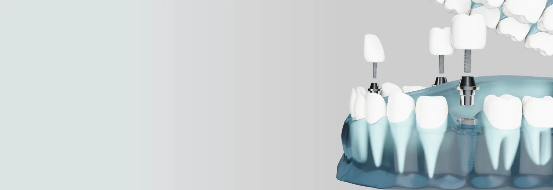 Computer guided dental implants at Roam Dental