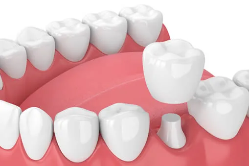 Dental crowns and bridges